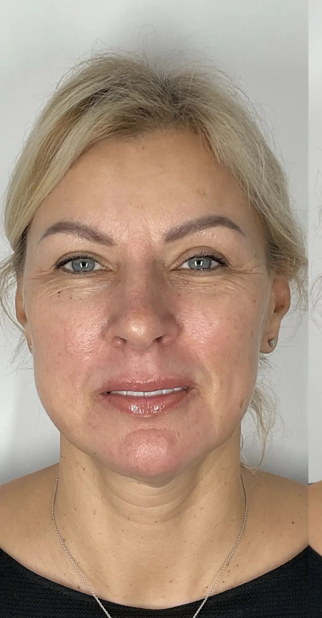 Before Botox Treatment